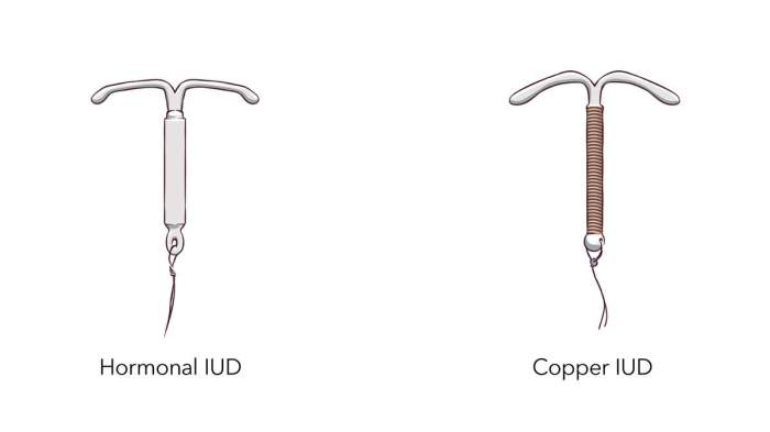 Iud ius iuc differences contraception intrauterine pregnancy device