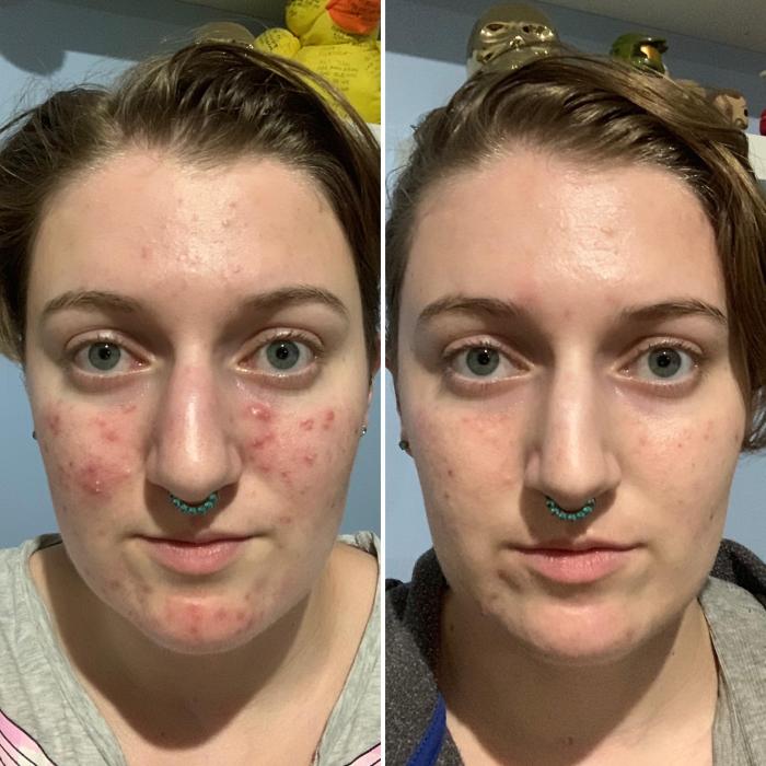 Best Birth Control for Acne